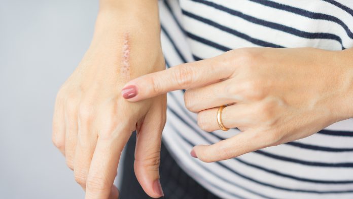 Transplanted hair follicles mend skin scars in a new study