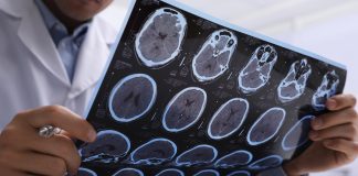 Experiencing multiple concussions linked to poor brain function