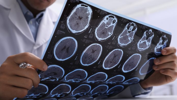Experiencing multiple concussions linked to poor brain function