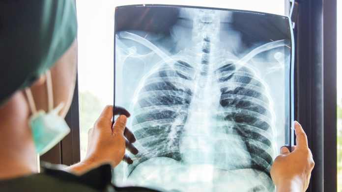 Using advanced imaging technology to detect lung disease