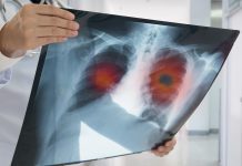 Researchers discover the mechanism behind lung adenocarcinoma