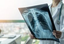 UK lung cancer death rates are predicted to fall in 2023