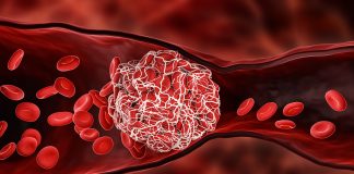 High BMI in childhood increases the risk of blood clots in later life