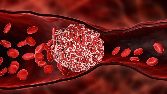 High BMI in childhood increases the risk of blood clots in later life