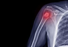 Researchers have developed a revolutionary new bone cancer treatment
