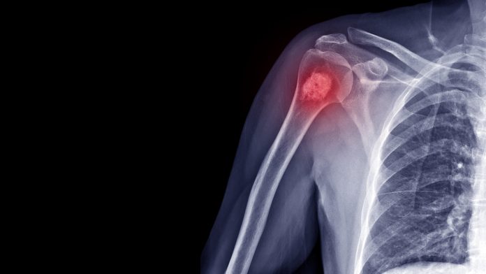 Researchers have developed a revolutionary new bone cancer treatment