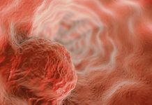 NHS introduces ‘sponge-on-a-string’ test for Barrett’s oesophagus Barrett’s oesophagus