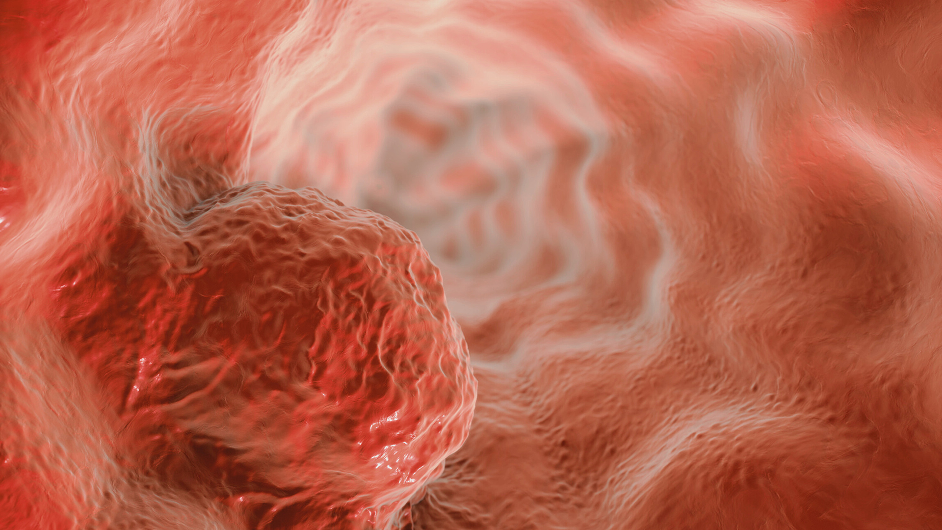 Barrett’s oesophagus