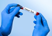 NHS pilot trials lung cancer blood test across thousands of patients lung cancer blood test
