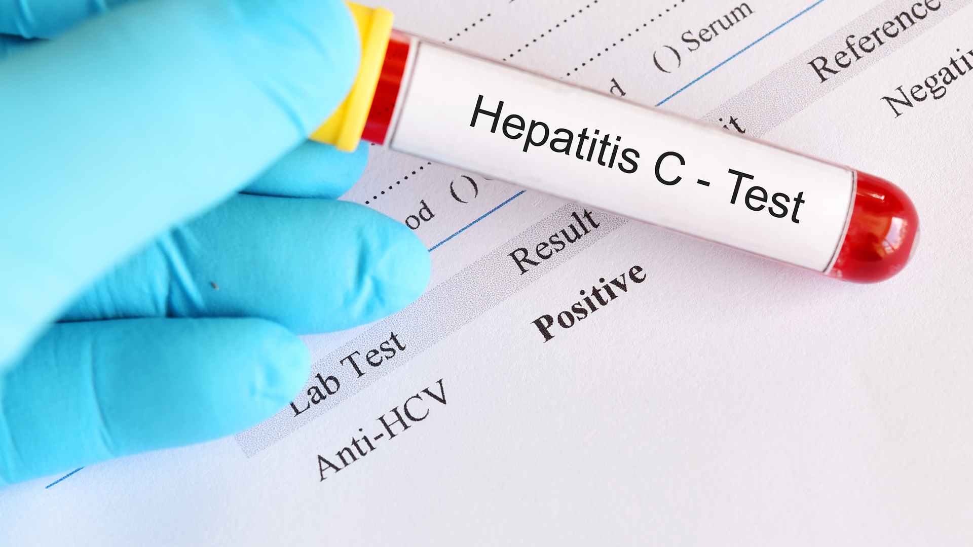 hepatitis C testing