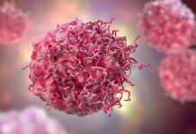 Neuroblastoma research could unlock more precise prognoses cancer