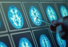 NHS approves breakthrough childhood brain tumour treatment brain tumour treatment