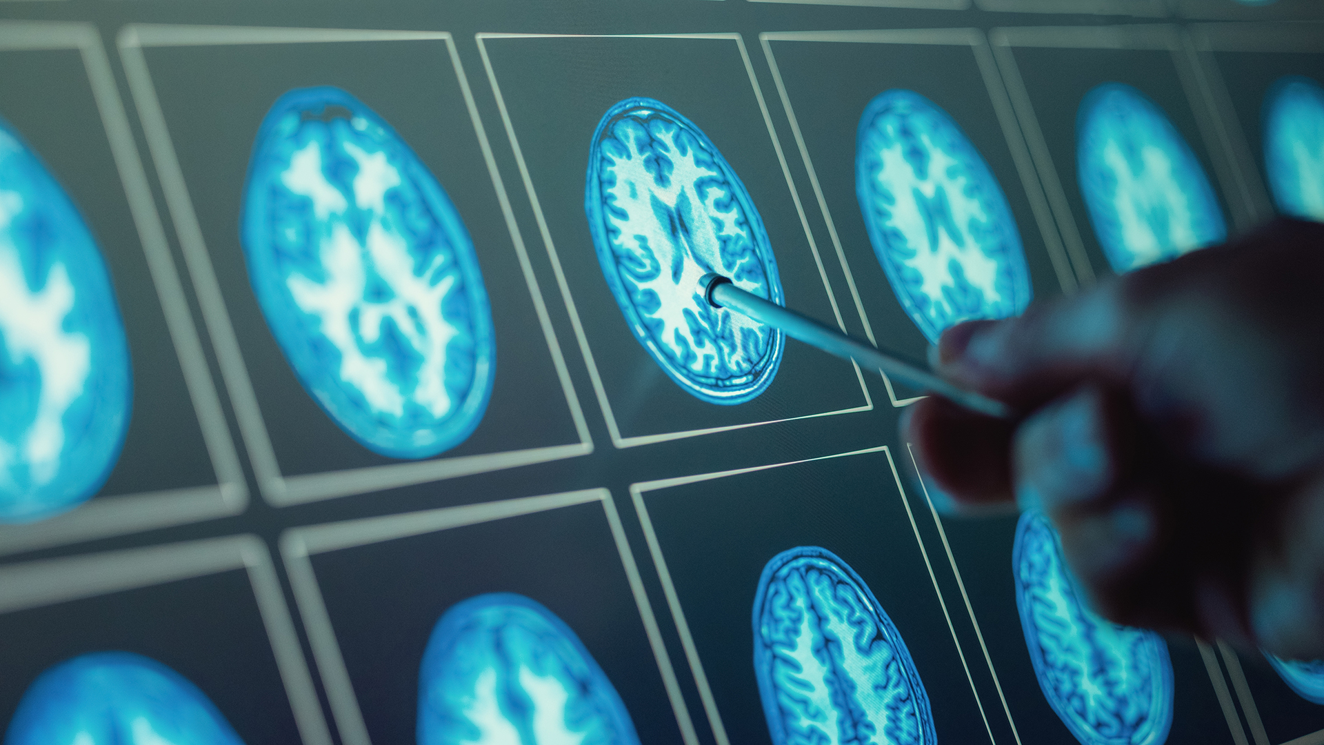 brain tumour treatment