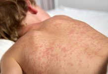 Measles vaccine less likely to work for C-section children Measles vaccine less likely to work for C-section children