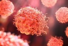 Glowing dye aids surgeons in eliminating prostate cancer cells Glowing dye aids surgeons in eliminating prostate cancer cells