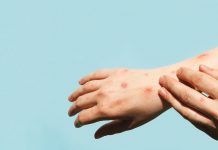 Mpox Explained: Everything You Need to Know About This Viral Outbreak Mpox Explained: Everything You Need to Know About This Viral Outbreak